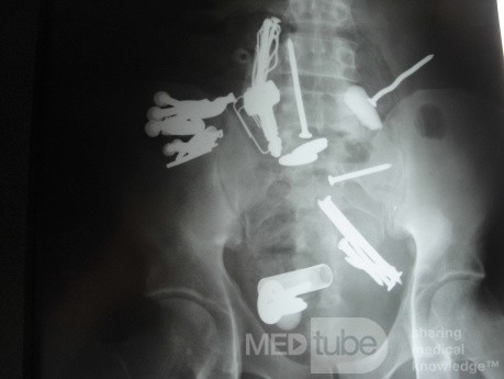 Multiple Foreign bodies in the GI tract (11 of 12)
