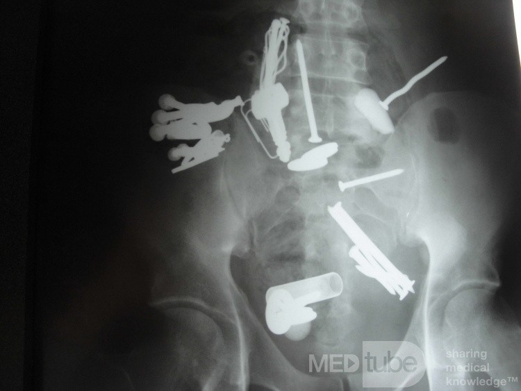 Multiple Foreign bodies in the GI tract (11 of 12)