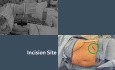 Low Anterior Access for Retroperitoneal Single-Port Robotic Partial Nephrectomy