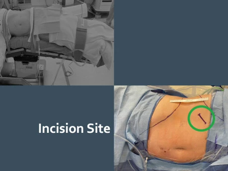 Low Anterior Access for Retroperitoneal Single-Port Robotic Partial Nephrectomy