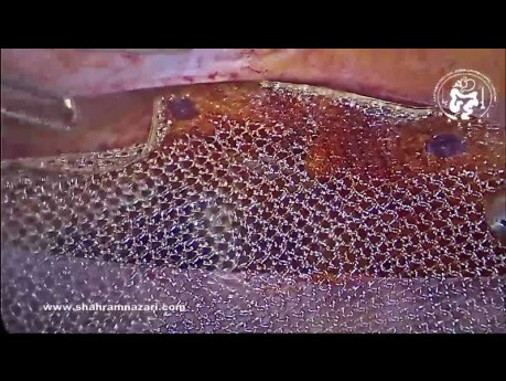Primarily Hernia-Sac-Abandon in TAPP Hernioplasty