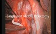 Single Port VATS Lobetomy Using Vascular Clips