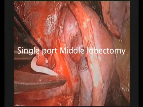 Single Port VATS Lobetomy Using Vascular Clips