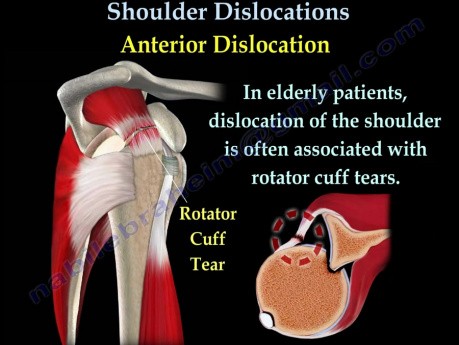 Shoulder Dislocations - Conditions and Treatment