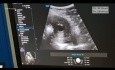 Laparoscopy & Ultrasonography Guided Microwave Ablation Of Adenomyosis (LUMWA)
