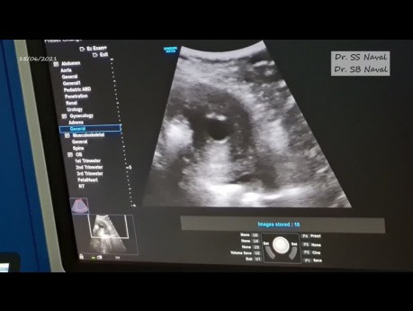 Laparoscopy & Ultrasonography Guided Microwave Ablation Of Adenomyosis (LUMWA)