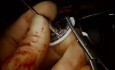 Mitral Valve Repair