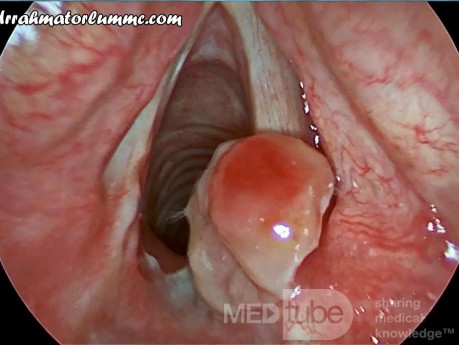 Pyogenic Granuloma of The Arytenoid