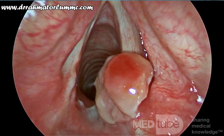 Pyogenic Granuloma of The Arytenoid