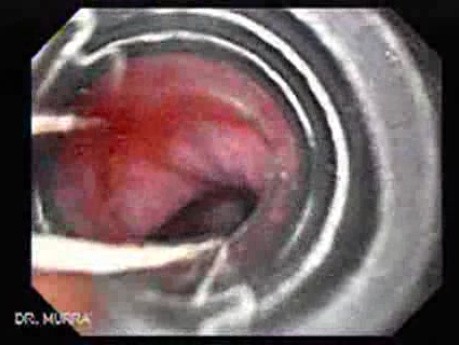 Alcoholic Cirrhosis - Banding of the Varix, Part 1