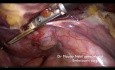 Tips and Tricks. Subtotal Hysterectomy for 1340 Grammes Uterus