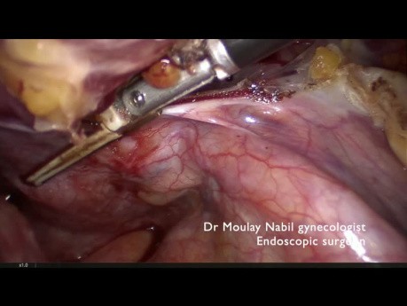Tips and Tricks. Subtotal Hysterectomy for 1340 Grammes Uterus