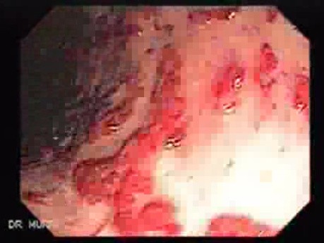 Multiple Rectal Ulcers (19 of 110)