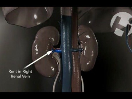 Retroperitoneal Bleed from the Right Kidney