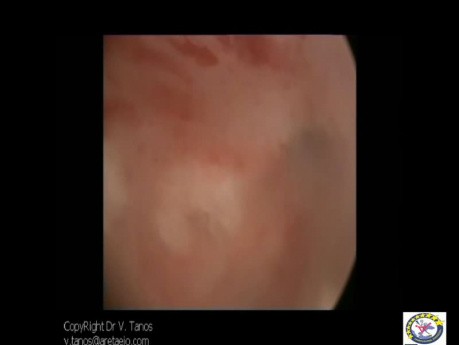 IUA Connecting Band Anterior With Posterior Wall Adhesions