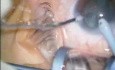 Cataract Surgery - Phacoemulsification