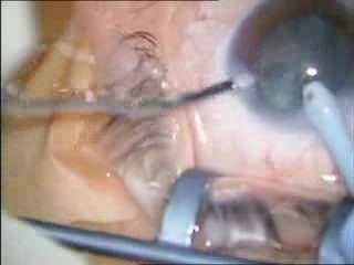 Cataract Surgery - Phacoemulsification