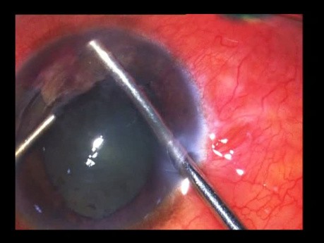 Anterior Segment IOFB