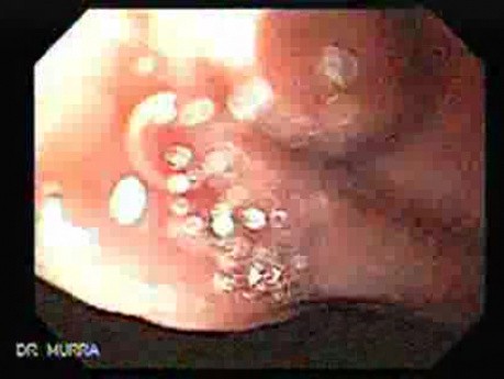 Upside-down Stomach (1 of 3)