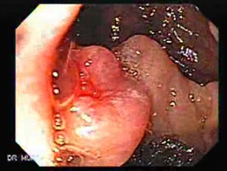 Cholangiocarcinoma (1 of 4)