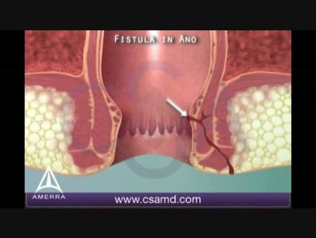 Fistula in Ano - 3D Medical Animation
