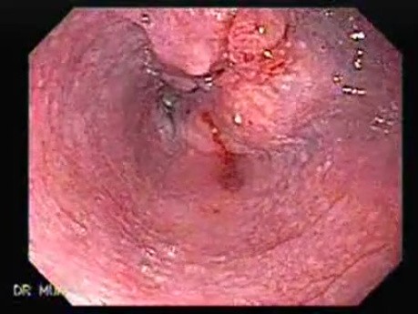 Esophageal Squamous Cell Carcinoma (2 of 3 )