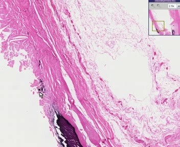 Aorta - Atherosclerosis 2