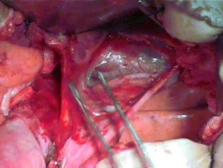 Anatomy of the Pelvis with Surgical Assessment (for Radical Hysterectomy) - Three Posterior Avascular Spaces
