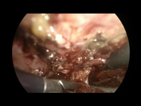Prostato-Symphyseal Fistula. Extraperitoneal Laparoscopic Correction.