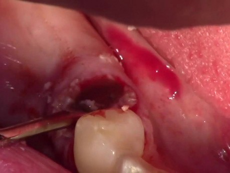 Extraction #29 Root Tip With Simple Socket Bone Grafting