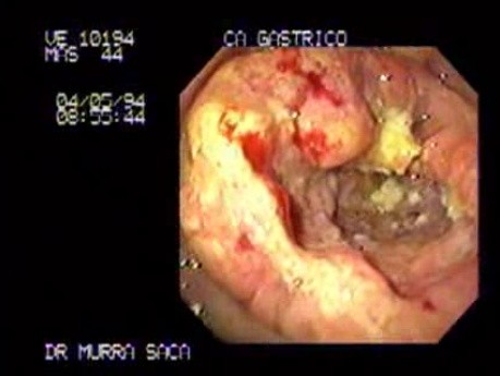 Adenocarcinoma of the Antrum