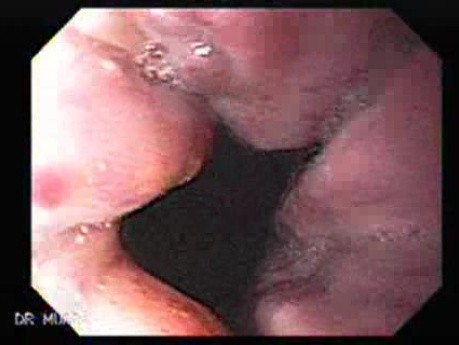 Esophageal Ulcer - Post Sclerotherapy - First Look at the Esophageal Mucosa