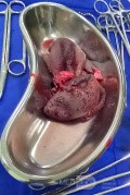 Meningocele in an 18-year-old patient