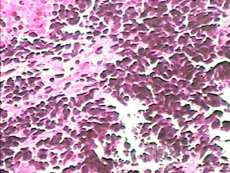 Small cell carcinoma of the lung that invades the upper and
 the middle third of the Esophagus (6 of 7)