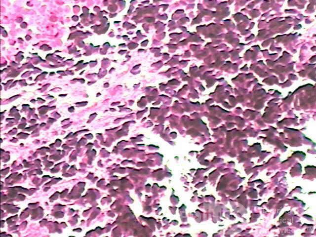 Small cell carcinoma of the lung that invades the upper and
 the middle third of the Esophagus (6 of 7)