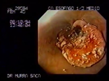 Esophageal Squamous Cell Carcinoma - case 2