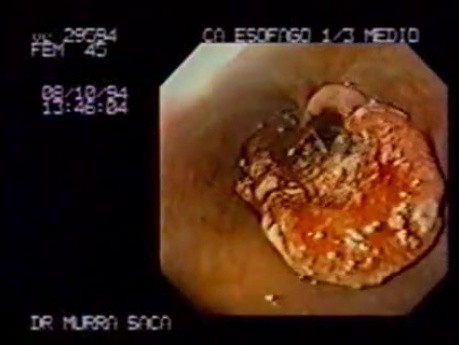 Esophageal Squamous Cell Carcinoma - case 2