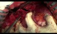 Surgery for Primary Hepatocellular Carcinoma