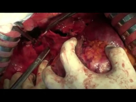 Surgery for Primary Hepatocellular Carcinoma