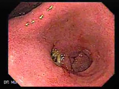 Multiple Gastric Ulcers - Endoscopy (5 of 10)
