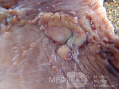 Early Gastric Cancer (14 of 21)