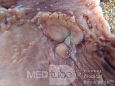 Early Gastric Cancer (14 of 21)