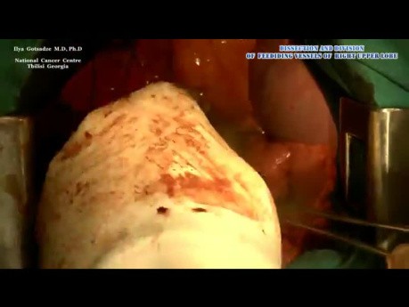 Open Right Upper Lobectomy with Mediastinal Lymphadenectomy for Lung Cancer (NSLC)