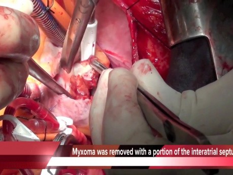 Left Atrial Myxoma Resection