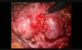 Laparoscopic Pyelolithotomy in Horseshoe Kidney