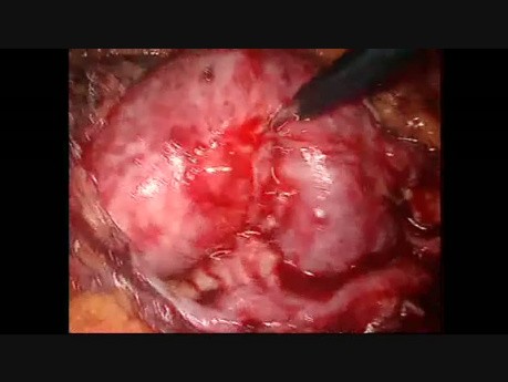 Laparoscopic Pyelolithotomy in Horseshoe Kidney