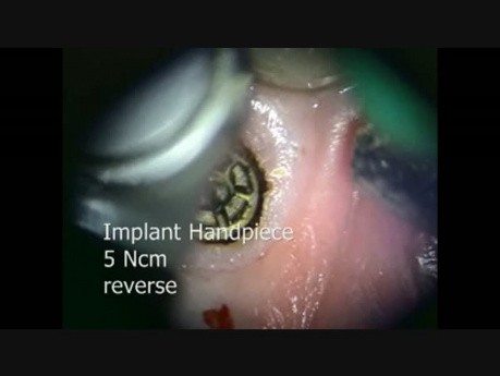 Broken Implant Screw Removal