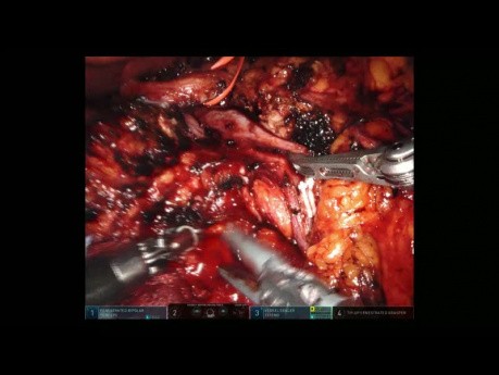 Robotic Pancreaticoduodenectomy Performed for Pancreatic Head Cancer
