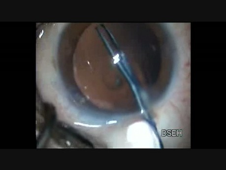  Anterior and Posterior Rhexis in Posterior Polar Cataract