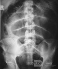 Gastrointestinal Tract Obstruction